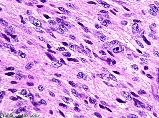 Desmoplastic infantile ganglioglioma, H&E stain x400